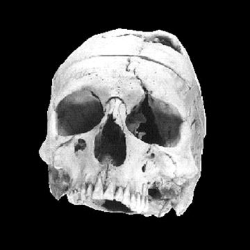 Reconstruction of Phineas Gage's skull, Department of Neurology, University of Iowa