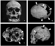 Photo credit: Alena Sefcakova, Slovak National Museum; Description: DIAGNOSIS Evidence of tumors in the skull of a male skeleton exhumed from an early medieval cemetery in Slovakia. Often thought of as a modern disease, cancer has always been with us. Photo credit: Alena Sefcakova, Slovak National Museum; Description: DIAGNOSIS Evidence of tumors in the skull of a male skeleton exhumed from an early medieval cemetery in Slovakia. Often thought of as a modern disease, cancer has always been with us.